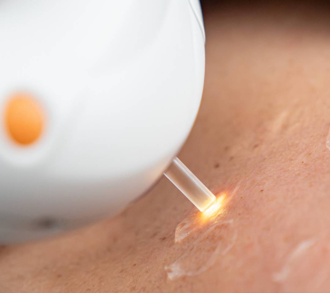 Cuello y escote Tratamientos con aparatología