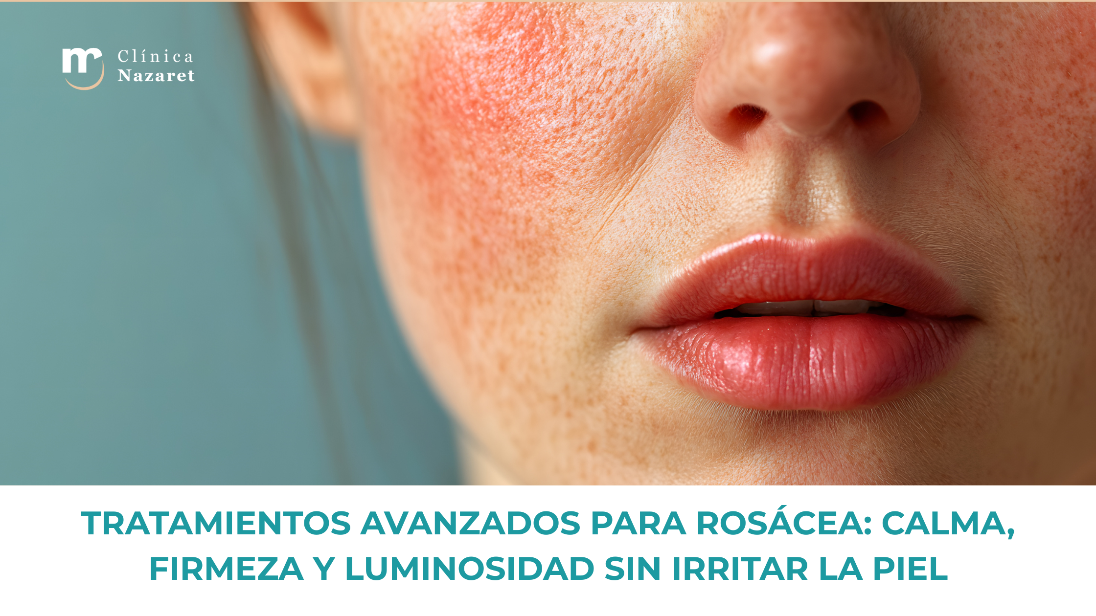 Primer plano de un rostro con rosácea y enrojecimiento en mejillas, mostrando irritación y textura característica de piel sensible.